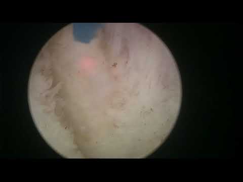 Real-life HoLEP 20: Difficult dissection plane