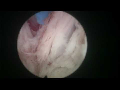 Real Life HoLEP Cases númber 9: En bloc HoLEP with early apical release on a bulky prostate