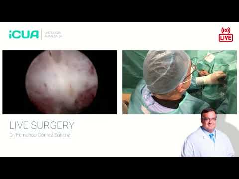 Live transmission: 2 cases of HoLEP with Virtual Basket
