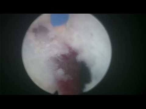RLHoLEPCase33: HoLEP after REZUM