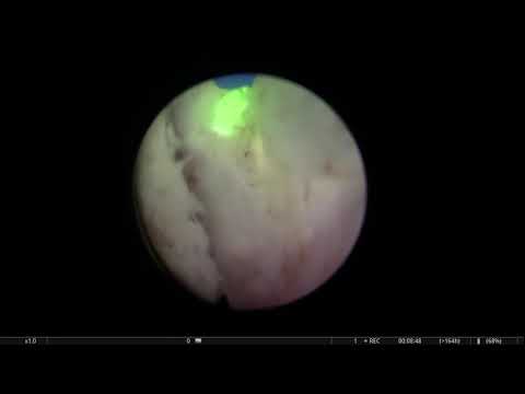 Real-life HoLEP 22: Low power Holmium laser (18 Hz, 2,2 J) in a patient with many BPH nodules