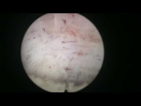 Real life MoLEP Case Number 5