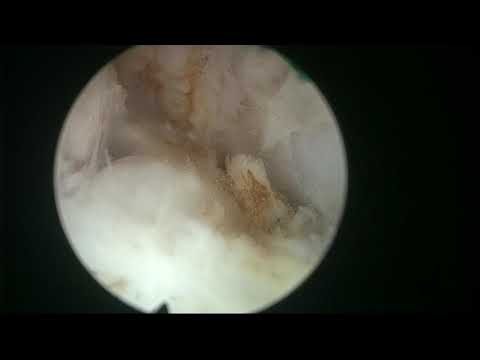 Real life case 11: a biggish prostate with a subcervical nodule.