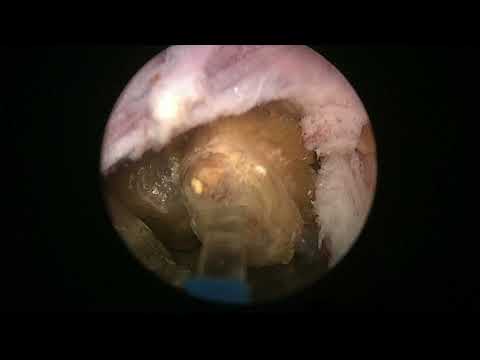 RLHoLEPcase 32: Stony prostate, unusual case, not en bloc this time...