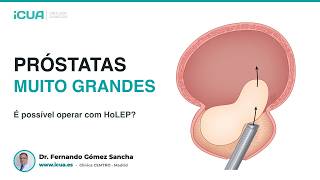 Próstatas muito grandes: é possível operar com HoLEP?