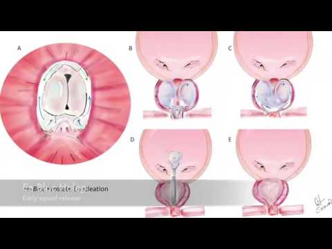 Redo En bloc HoLEP with early apical release after different previous endoscopic treatments