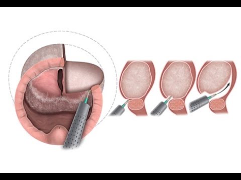 HoLEP Technique in 8 Minutes with Drawings — EAU 2022 Award Video