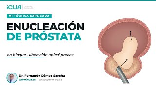 Enucleación en bloque con liberación apical precoz — Mi técnica explicada