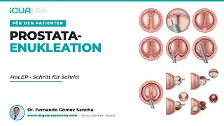 Die HoLEP-Operation Schritt für Schritt