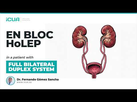 En Bloc HoLEP With 4 Ureters — Complete Bilateral Duplex System