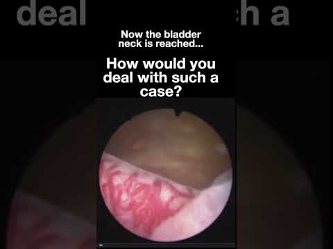 En bloc HoLEP is specially good for Re-do cases #holep #prostatesurgery #lasersurgery #urology