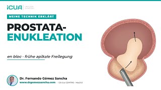 En Bloc HoLEP mit früher apikaler Freisetzung - Meine Technik erklärt