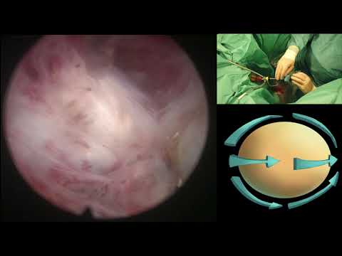 En Bloc HoLEP — Special Case Demonstration of Apical Release Technique