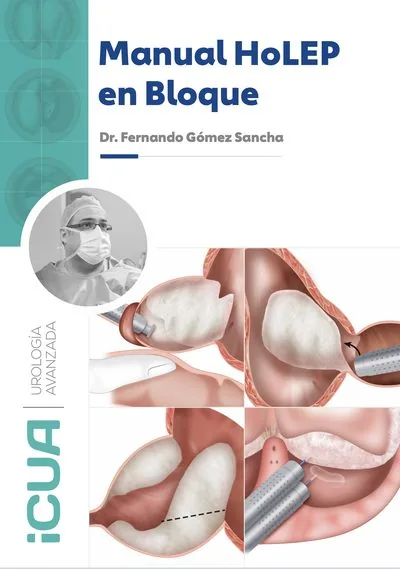 Copertina del Manual de HoLEP en Bloque del Dr. Fernando Gómez Sancha
