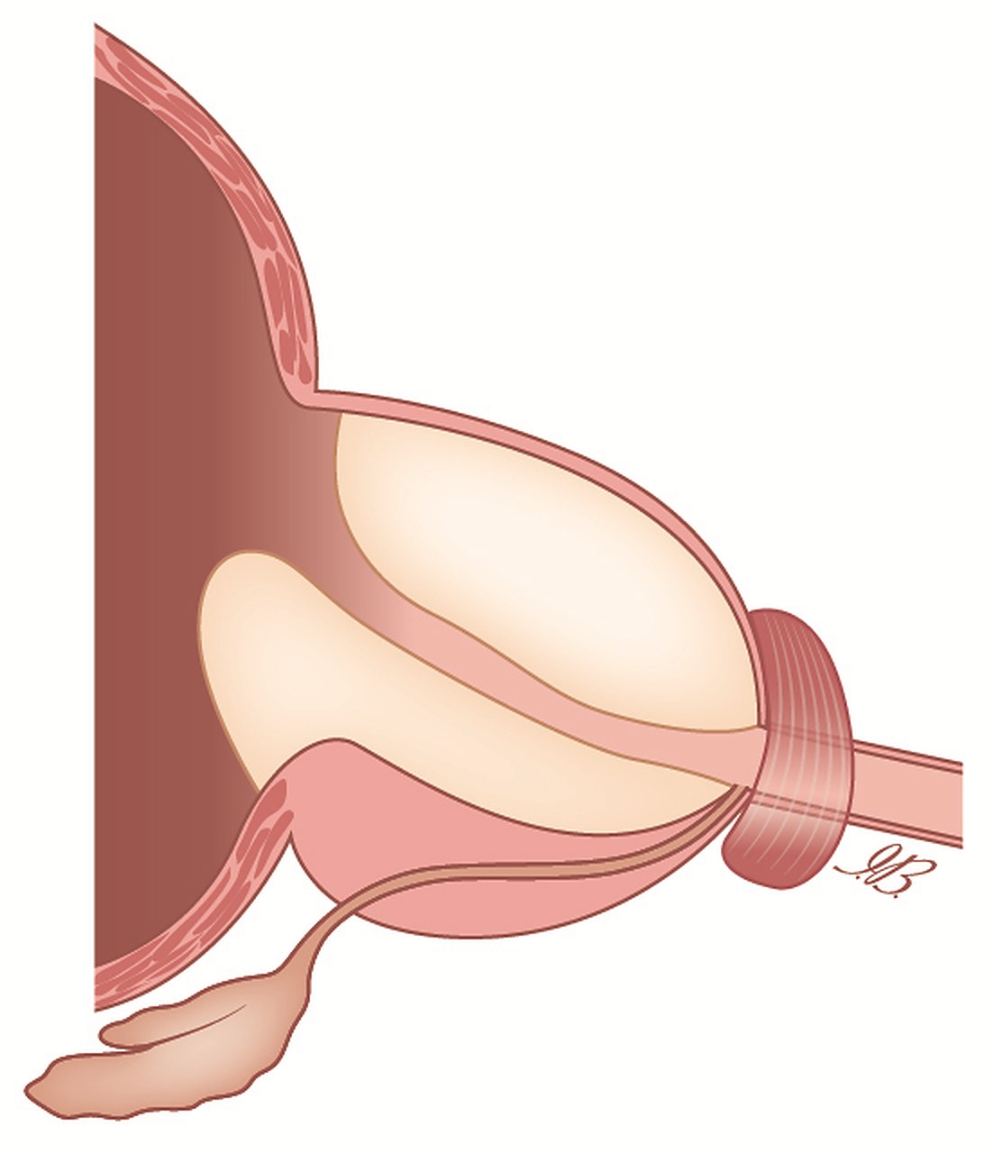 Prima: l’adenoma all’interno della prostata