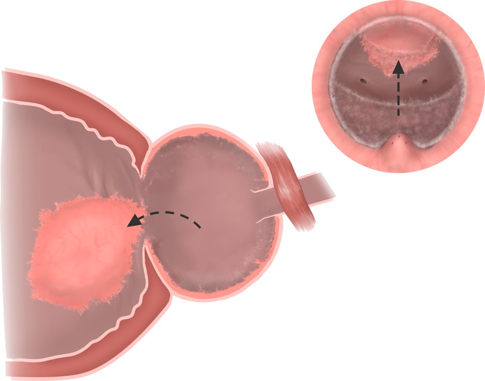 Enucleazione: l’intero adenoma passa nella vescica