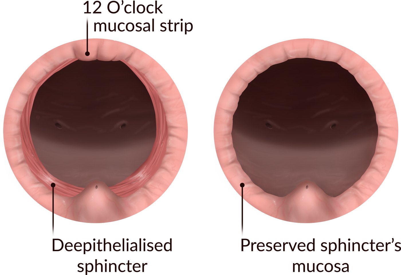 The sphincter at the end of the operation: before and now