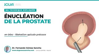 HoLEP en bloc avec libération apicale précoce - Ma technique expliquée