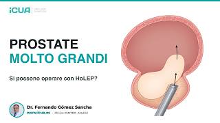 Prostate molto grandi: si possono operare con HoLEP?