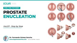 HoLEP Surgery Step by Step