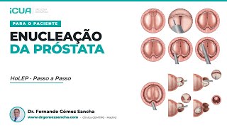 A operação HoLEP passo a passo